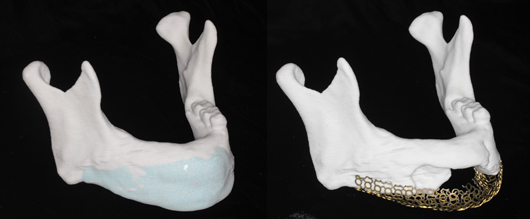 顎骨再建手術に用いるシミュレーション模型とチタンメッシュの製作