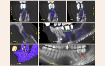術前のインプラントシミュレーション