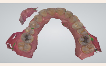 歯列の3Dデータ